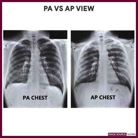 what is ap lateral x ray